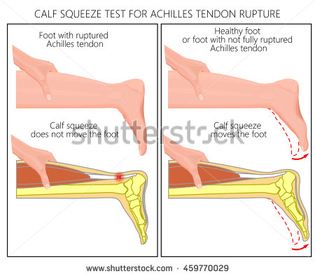 stock-vector-illustration-of-a-calf-squeeze-test-achilles-tendon-rupture-external-and-skeletal-view-of-an-ankle-459770029-test