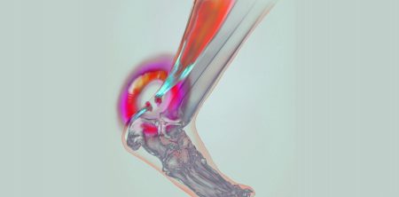 Tendinite d’Achille